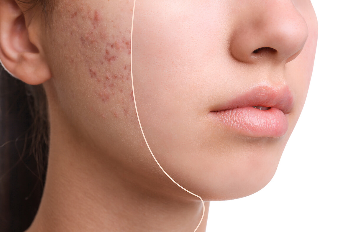 management-of-acne-vulgaris-what-are-your-treatment-options.jpg