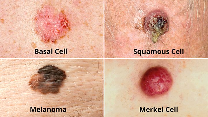 what-are-the-different-types-of-skin-cancer-722x406-1.jpg